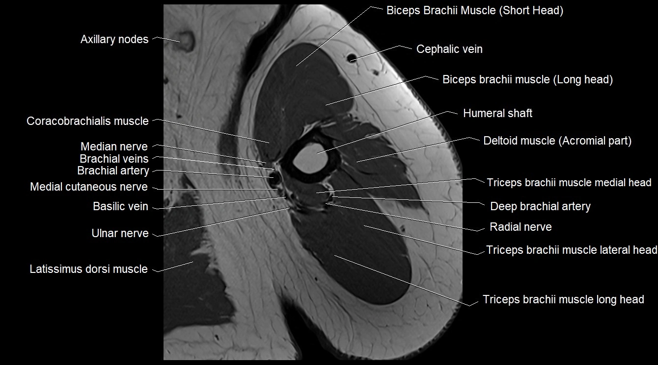 Upper arm( humerus) cross section anatomy MRI 3T axial image 27.webp